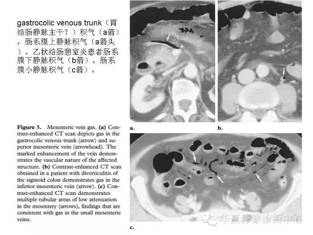 【PPT】门脉积气的CT表现和鉴别
