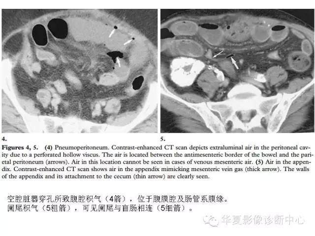 【PPT】门脉积气的CT表现和鉴别