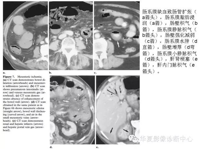 【PPT】门脉积气的CT表现和鉴别