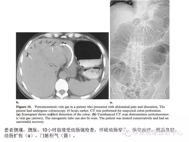 【PPT】门脉积气的CT表现和鉴别