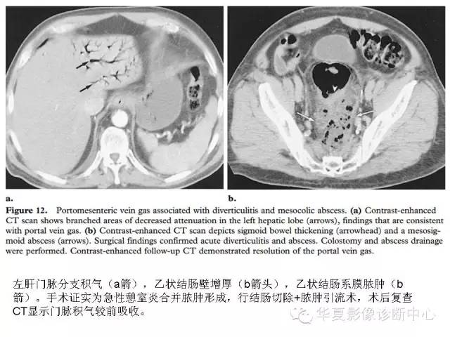 【PPT】门脉积气的CT表现和鉴别