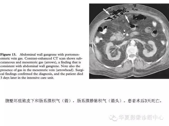 【PPT】门脉积气的CT表现和鉴别