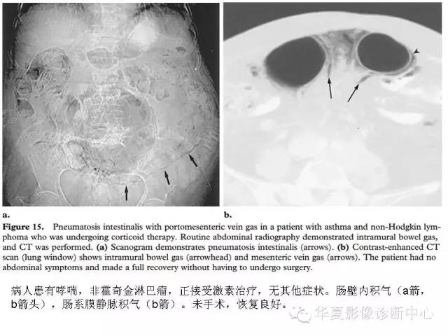 【PPT】门脉积气的CT表现和鉴别