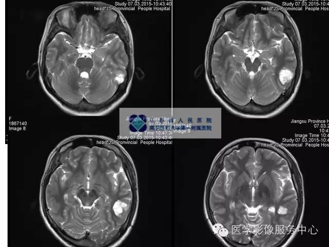 【病例】胚胎发育不良性神经上皮瘤DNET一例MR影像表现 【病例】胚胎发育不良性神经上皮瘤DNET一例MR影像表现