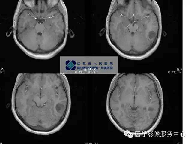 【病例】胚胎发育不良性神经上皮瘤DNET一例MR影像表现 【病例】胚胎发育不良性神经上皮瘤DNET一例MR影像表现