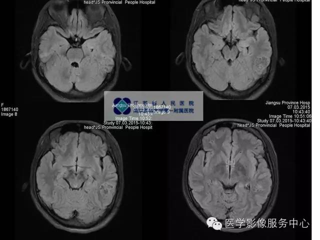 【病例】胚胎发育不良性神经上皮瘤DNET一例MR影像表现 【病例】胚胎发育不良性神经上皮瘤DNET一例MR影像表现