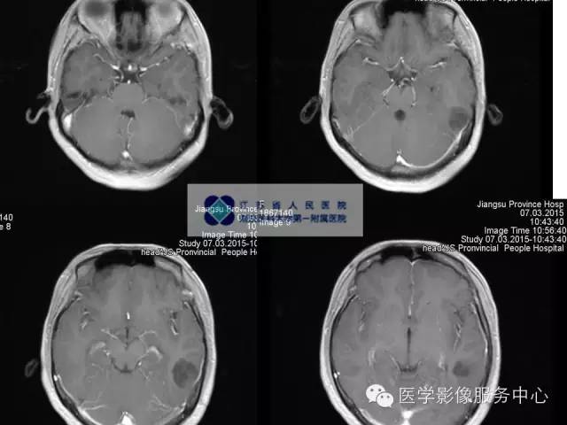 【病例】胚胎发育不良性神经上皮瘤DNET一例MR影像表现 【病例】胚胎发育不良性神经上皮瘤DNET一例MR影像表现