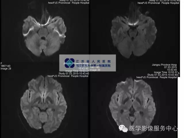 【病例】胚胎发育不良性神经上皮瘤DNET一例MR影像表现 【病例】胚胎发育不良性神经上皮瘤DNET一例MR影像表现