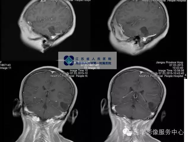 【病例】胚胎发育不良性神经上皮瘤DNET一例MR影像表现 【病例】胚胎发育不良性神经上皮瘤DNET一例MR影像表现