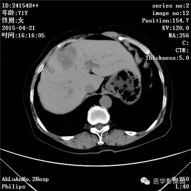 【病例】胆管细胞癌1例CT影像表现 【病例】胆管细胞癌1例CT影像表现