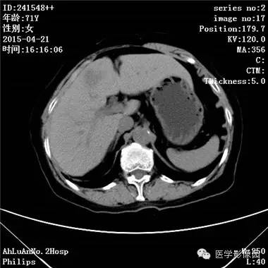 【病例】胆管细胞癌1例CT影像表现 【病例】胆管细胞癌1例CT影像表现