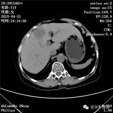 【病例】胆管细胞癌1例CT影像表现 【病例】胆管细胞癌1例CT影像表现