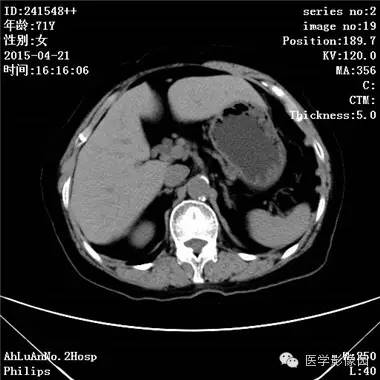 【病例】胆管细胞癌1例CT影像表现 【病例】胆管细胞癌1例CT影像表现