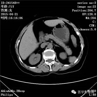 【病例】胆管细胞癌1例CT影像表现 【病例】胆管细胞癌1例CT影像表现