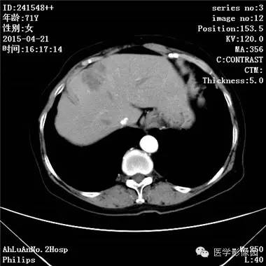 【病例】胆管细胞癌1例CT影像表现 【病例】胆管细胞癌1例CT影像表现