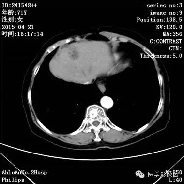 【病例】胆管细胞癌1例CT影像表现 【病例】胆管细胞癌1例CT影像表现