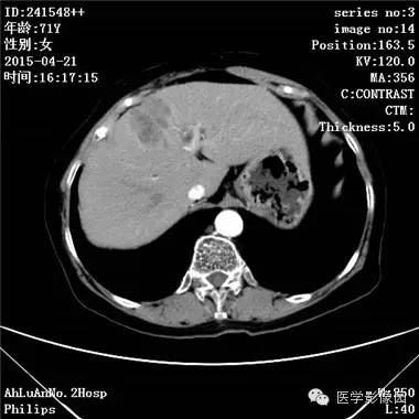 【病例】胆管细胞癌1例CT影像表现 【病例】胆管细胞癌1例CT影像表现