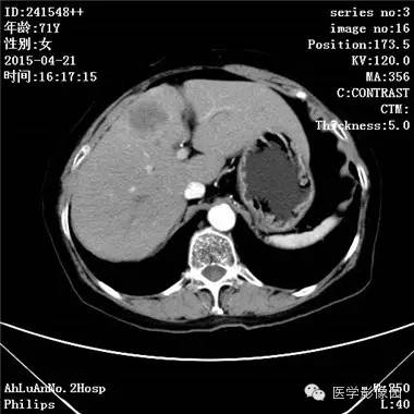 【病例】胆管细胞癌1例CT影像表现 【病例】胆管细胞癌1例CT影像表现