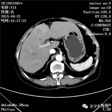 【病例】胆管细胞癌1例CT影像表现 【病例】胆管细胞癌1例CT影像表现