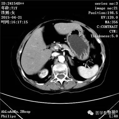 【病例】胆管细胞癌1例CT影像表现 【病例】胆管细胞癌1例CT影像表现