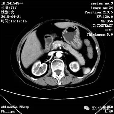 【病例】胆管细胞癌1例CT影像表现 【病例】胆管细胞癌1例CT影像表现