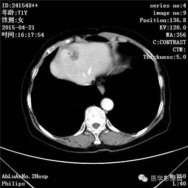 【病例】胆管细胞癌1例CT影像表现 【病例】胆管细胞癌1例CT影像表现