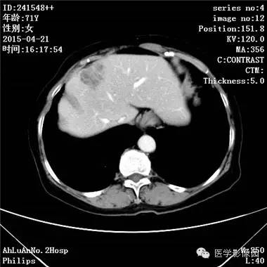 【病例】胆管细胞癌1例CT影像表现 【病例】胆管细胞癌1例CT影像表现