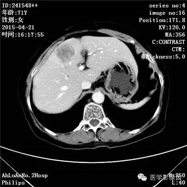 【病例】胆管细胞癌1例CT影像表现 【病例】胆管细胞癌1例CT影像表现