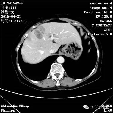 【病例】胆管细胞癌1例CT影像表现 【病例】胆管细胞癌1例CT影像表现