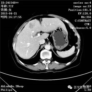 【病例】胆管细胞癌1例CT影像表现 【病例】胆管细胞癌1例CT影像表现