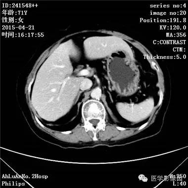 【病例】胆管细胞癌1例CT影像表现 【病例】胆管细胞癌1例CT影像表现