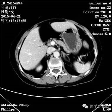 【病例】胆管细胞癌1例CT影像表现 【病例】胆管细胞癌1例CT影像表现