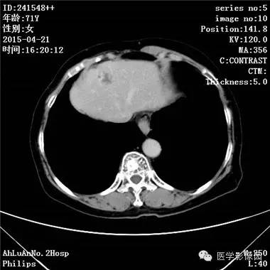 【病例】胆管细胞癌1例CT影像表现 【病例】胆管细胞癌1例CT影像表现