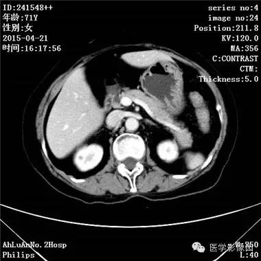 【病例】胆管细胞癌1例CT影像表现 【病例】胆管细胞癌1例CT影像表现