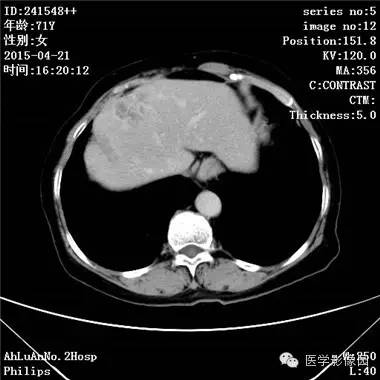 【病例】胆管细胞癌1例CT影像表现 【病例】胆管细胞癌1例CT影像表现