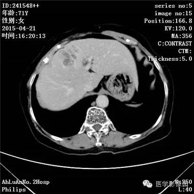 【病例】胆管细胞癌1例CT影像表现 【病例】胆管细胞癌1例CT影像表现