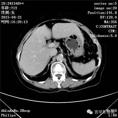 【病例】胆管细胞癌1例CT影像表现 【病例】胆管细胞癌1例CT影像表现