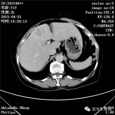 【病例】胆管细胞癌1例CT影像表现 【病例】胆管细胞癌1例CT影像表现