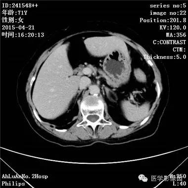 【病例】胆管细胞癌1例CT影像表现 【病例】胆管细胞癌1例CT影像表现