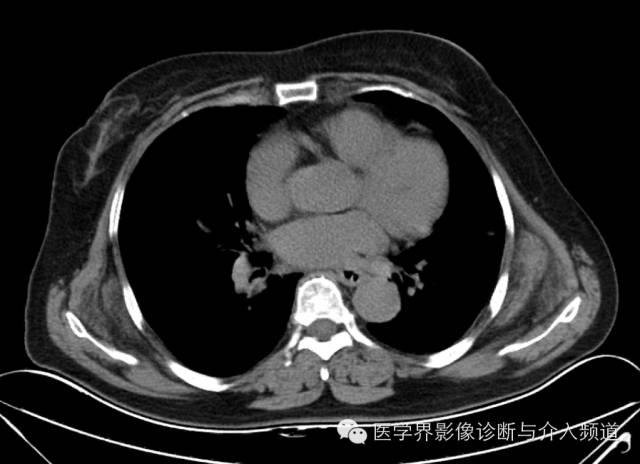 【病例】胸壁弹力纤维瘤1例CT影像表现 【病例】胸壁弹力纤维瘤1例CT影像表现