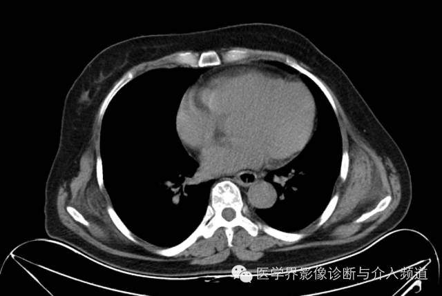 【病例】胸壁弹力纤维瘤1例CT影像表现 【病例】胸壁弹力纤维瘤1例CT影像表现
