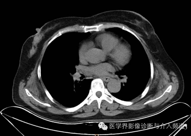 【病例】胸壁弹力纤维瘤1例CT影像表现 【病例】胸壁弹力纤维瘤1例CT影像表现