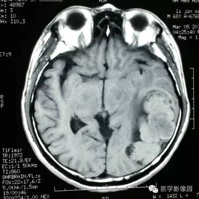 【病例】颅内血管外皮细胞瘤2例MR影像表现 【病例】颅内血管外皮细胞瘤2例MR影像表现