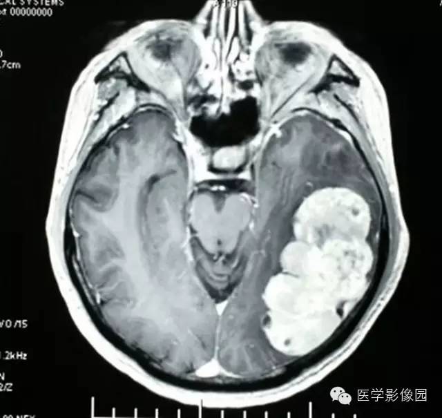 【病例】颅内血管外皮细胞瘤2例MR影像表现 【病例】颅内血管外皮细胞瘤2例MR影像表现