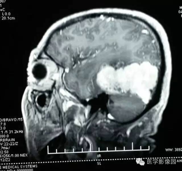 【病例】颅内血管外皮细胞瘤2例MR影像表现 【病例】颅内血管外皮细胞瘤2例MR影像表现