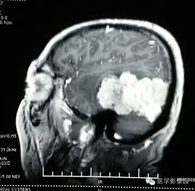 【病例】颅内血管外皮细胞瘤2例MR影像表现 【病例】颅内血管外皮细胞瘤2例MR影像表现