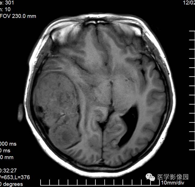 【病例】颅内血管外皮细胞瘤2例MR影像表现 【病例】颅内血管外皮细胞瘤2例MR影像表现