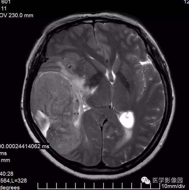 【病例】颅内血管外皮细胞瘤2例MR影像表现 【病例】颅内血管外皮细胞瘤2例MR影像表现