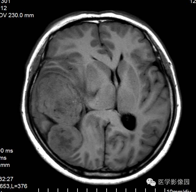 【病例】颅内血管外皮细胞瘤2例MR影像表现 【病例】颅内血管外皮细胞瘤2例MR影像表现