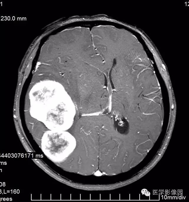 【病例】颅内血管外皮细胞瘤2例MR影像表现 【病例】颅内血管外皮细胞瘤2例MR影像表现